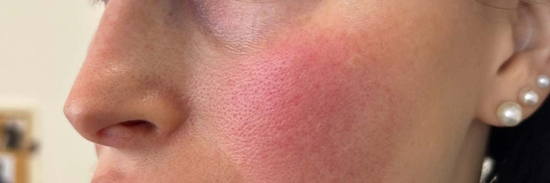 Redness and Flushing in UAE: A Calming Routine for Reactive Skin
